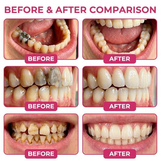 Cavity-Repair Natural Enamel Tooth Filling Gel