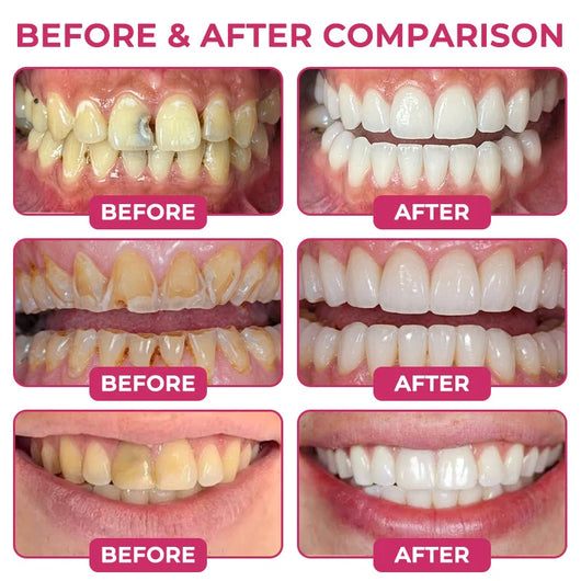 Cavity-Repair Natural Enamel Tooth Filling Gel