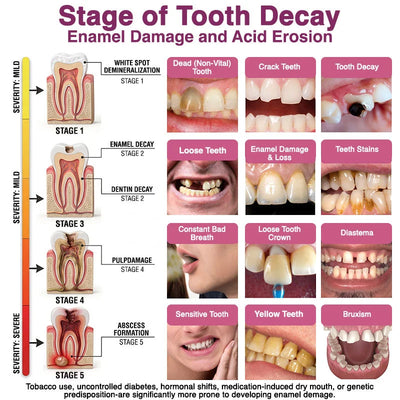 Cavity-Repair Natural Enamel Tooth Filling Gel