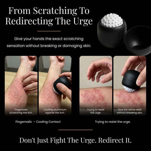 Eczema Itcher
