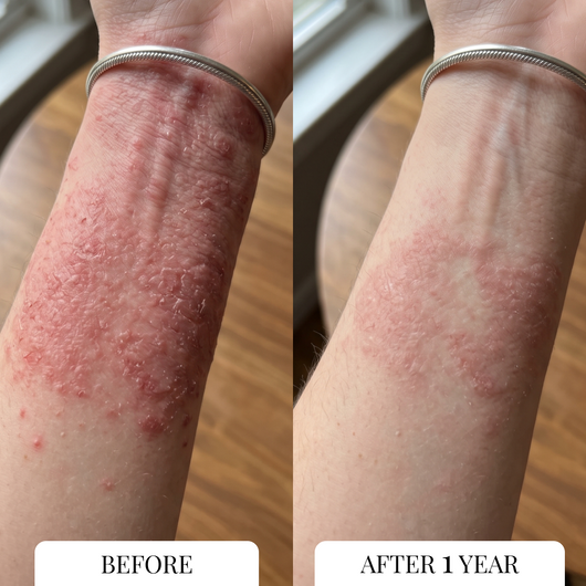 Eczema Itcher