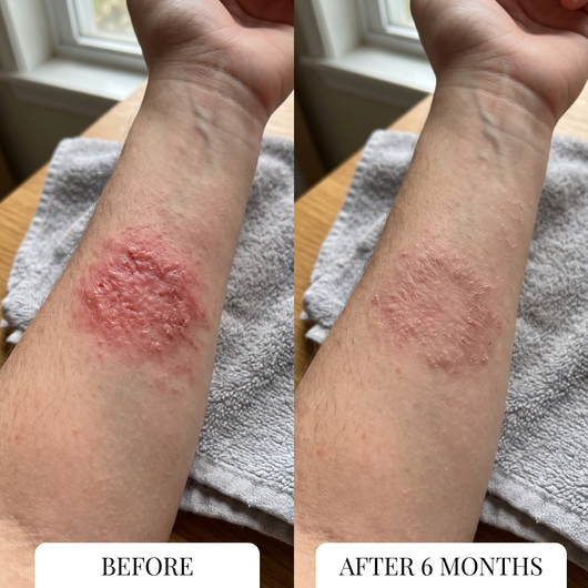 Eczema Itcher