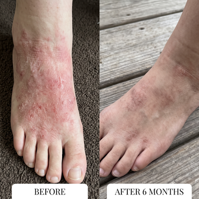 Eczema Itcher
