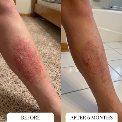 Eczema Itcher