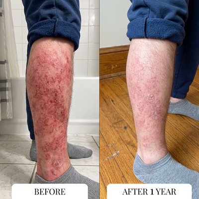 Eczema Itcher