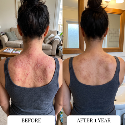 Eczema Itcher